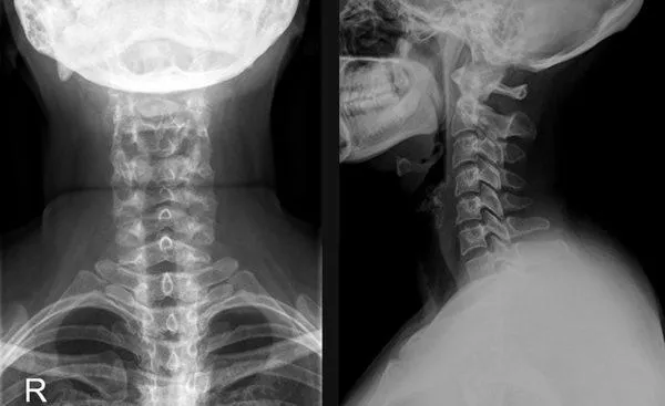 Рентгеновский снимок шейного отдела позвоночника