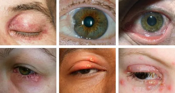 Признаки гиперплазии глаза