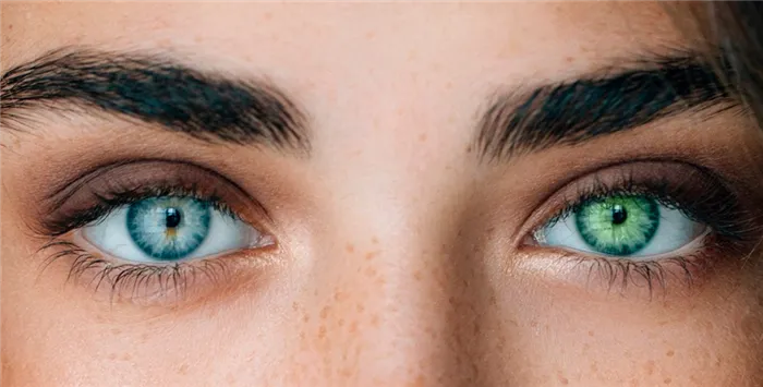 Фотографические примеры гетерохромии радужной оболочки глаза