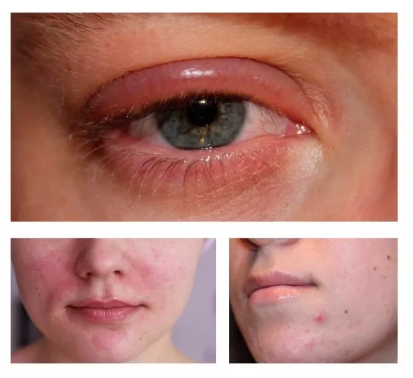 Примеры аллергических кожных реакций