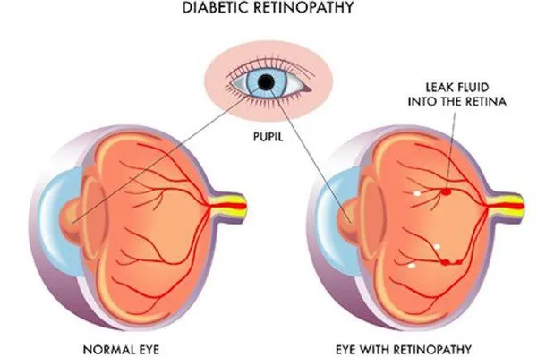 Диабетическая ретинопатия