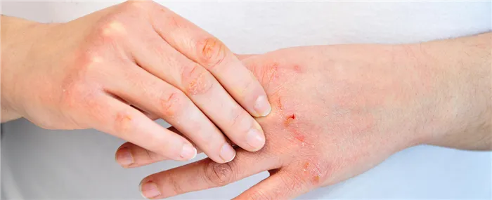 Поверхностная бактериальная инфекция кожи