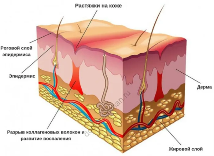 Растяжки.