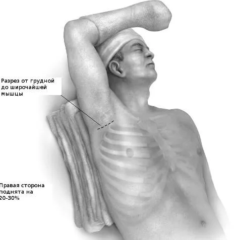 Пациент лежит на руках под углом 20-30 градусов.