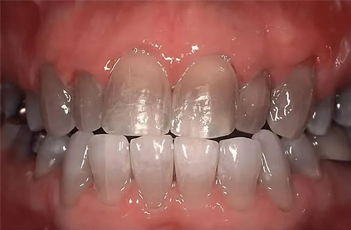 Тетрациклиновые зубы