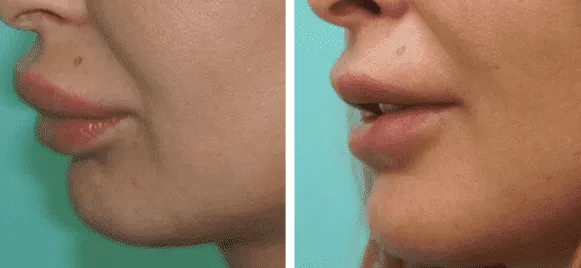 губы уточкой