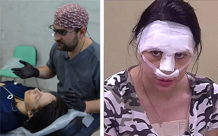 Фото после операции: Алена Рапунцель сделала ринопластику