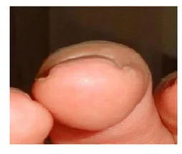 Платонихия или плоские ногти: как исправить форму? фото