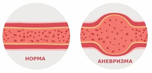 Аневризма артерии