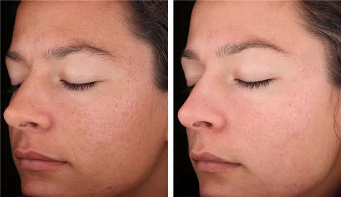 Фото до и после терапии улитками - борьба с угревой сыпью и другими проблемами на коже