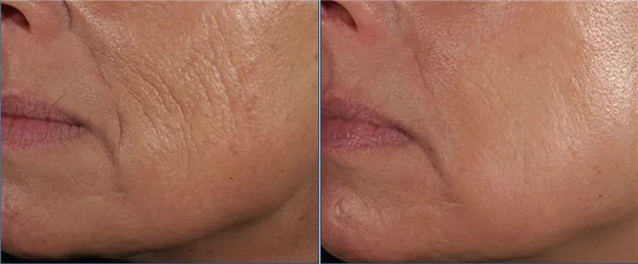 Фото до и после улиткотерапии - подтяжка лица, избавление от старческих морщин