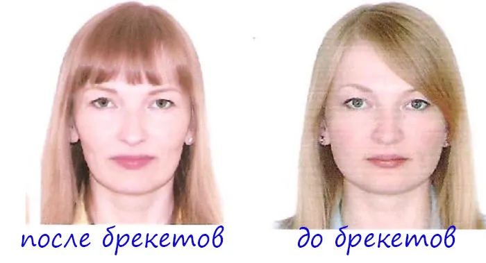 Овал лица после брекетов фото до и после