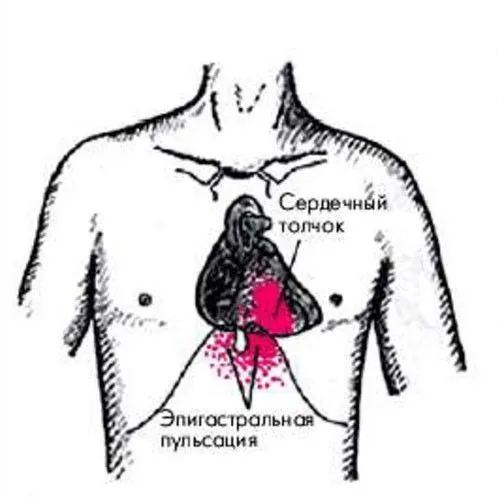 Эпигастральная пульсация