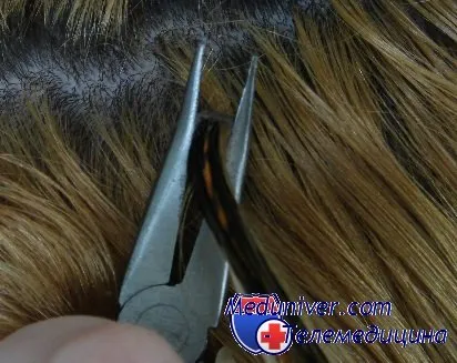 процесс снятия волос