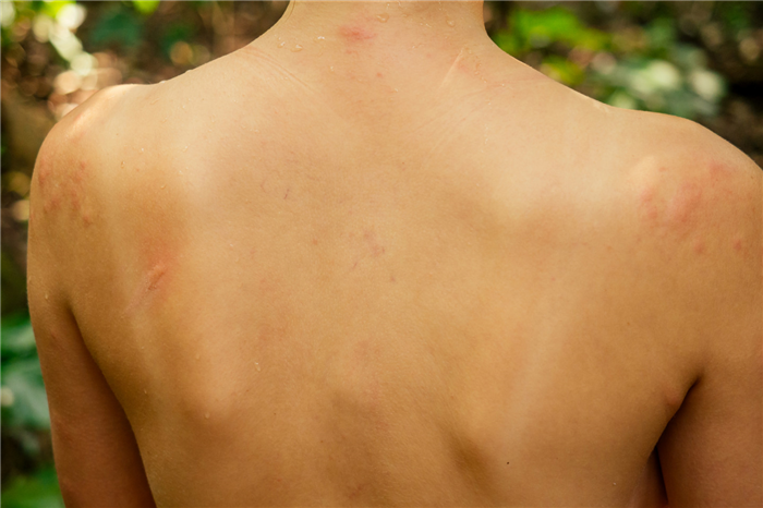 Общие признаки аллергии на солнце включают покраснение и зуд пораженных участков кожи