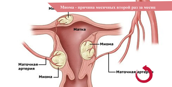 Менструация второй раз за месяц при миоме