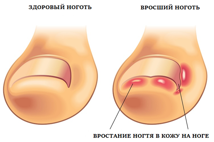 Как выглядит вросший ноготь